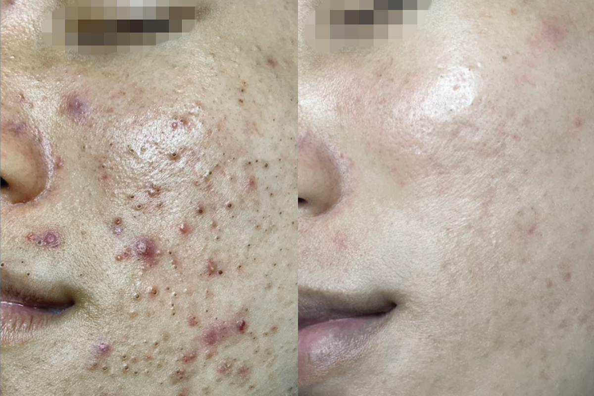 Lăn kim phi kim mụn sần