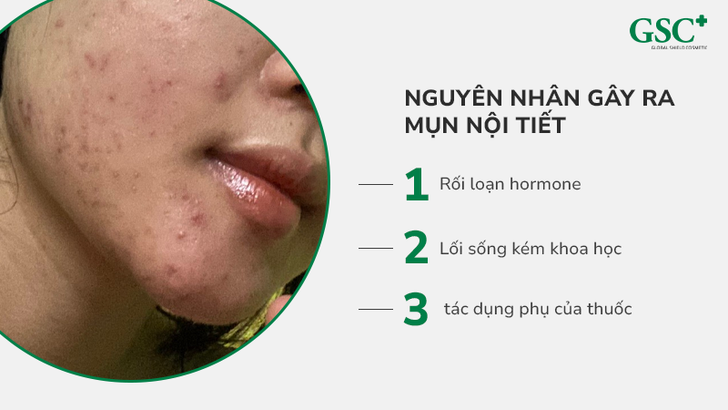 Nguyên nhân hình thành mụn nội tiết