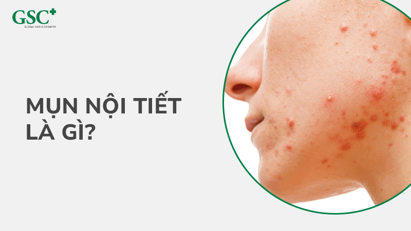 Khái niệm mụn nội tiết