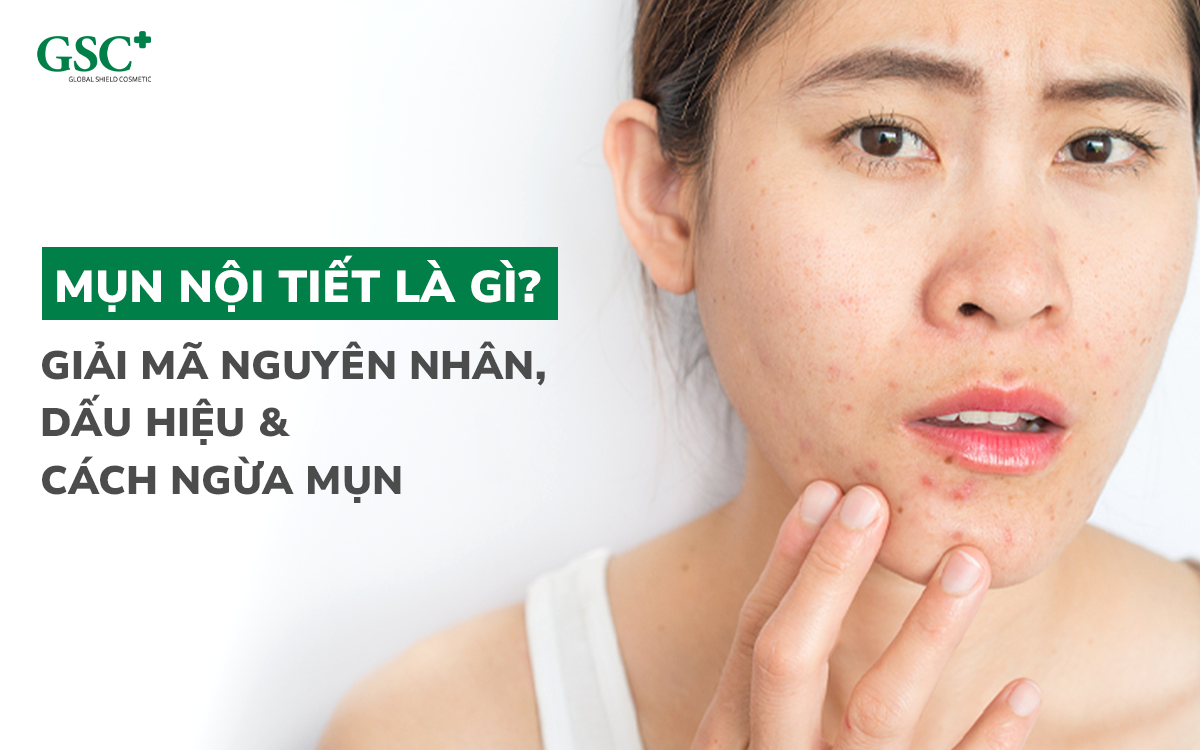 Mụn nội tiết là gì