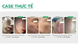 Workshop: Giải pháp tăng sắc tố sau viêm & tổn thương da Workshop: Giải pháp tăng sắc tố sau viêm & tổn thương da