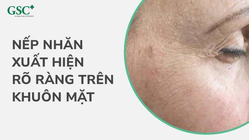 Xuất hiện nếp nhăn rõ ràng trên mặt