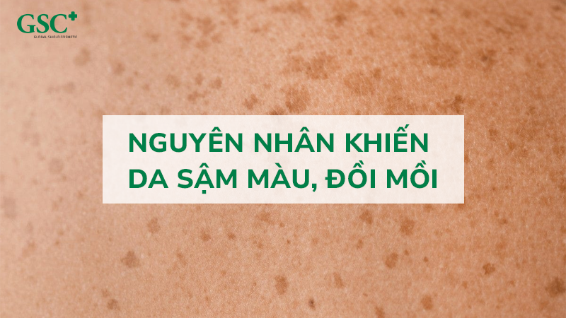 Nguyên nhân khiến da sậm màu, đồi mồi