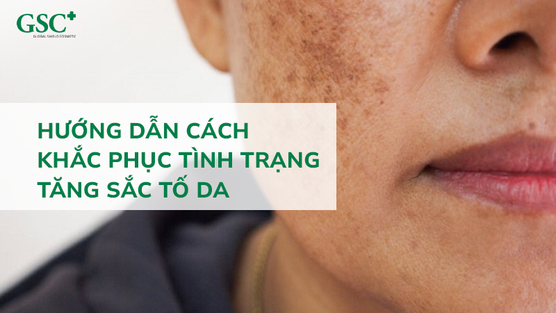 Hướng dẫn cách khắc phục tình trạng tăng sắc tố da