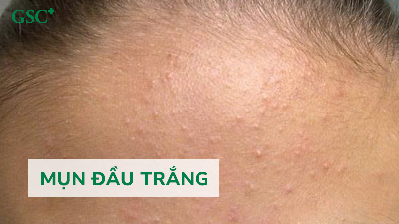 Mụn đầu trắng