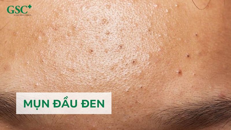 Mụn Đầu Đen