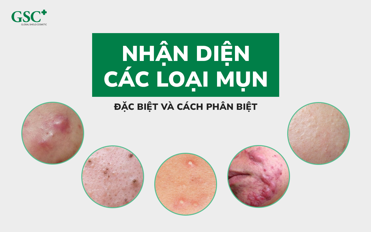 Các loại mụn ở mặt