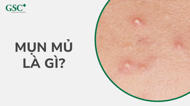 Mụn mủ là gì?