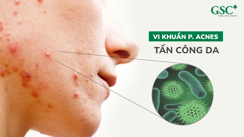 Vi khuẩn P. Acnes tấn công da