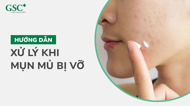 Hướng dẫn xử lý khi mụn mủ bị vỡ