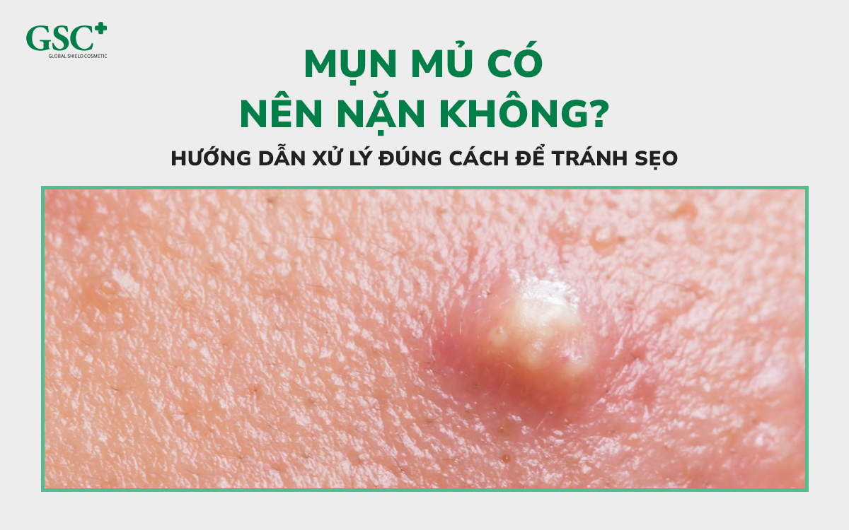 Mụn mủ có nên nặn không