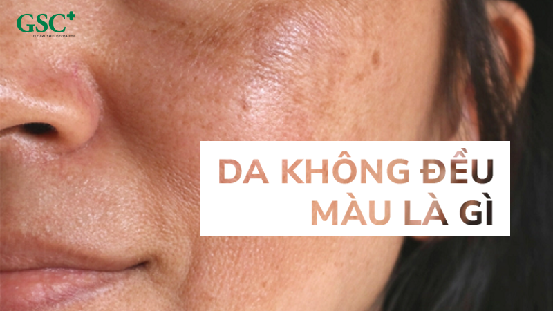 Da không đều màu là gì