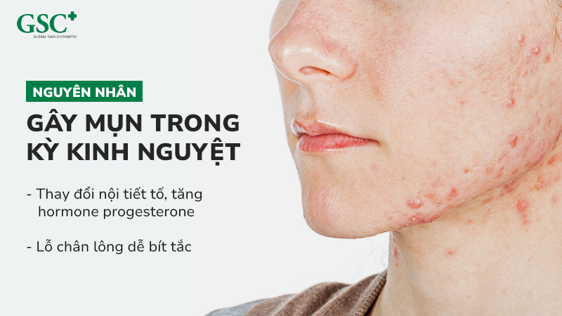 Nguyên nhân gây mụn trong kỳ kinh nguyệt