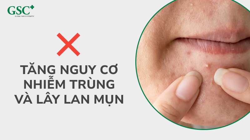 Tăng nguy cơ nhiễm trùng và lây lan mụn