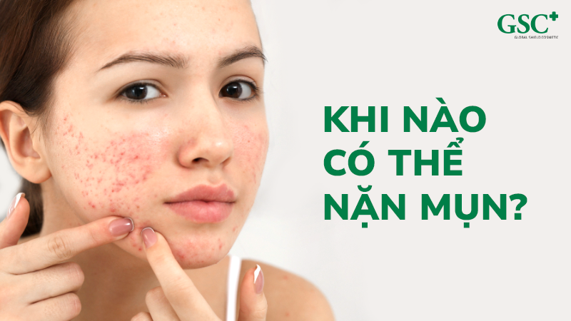 Khi nào có thể nặn mụn?