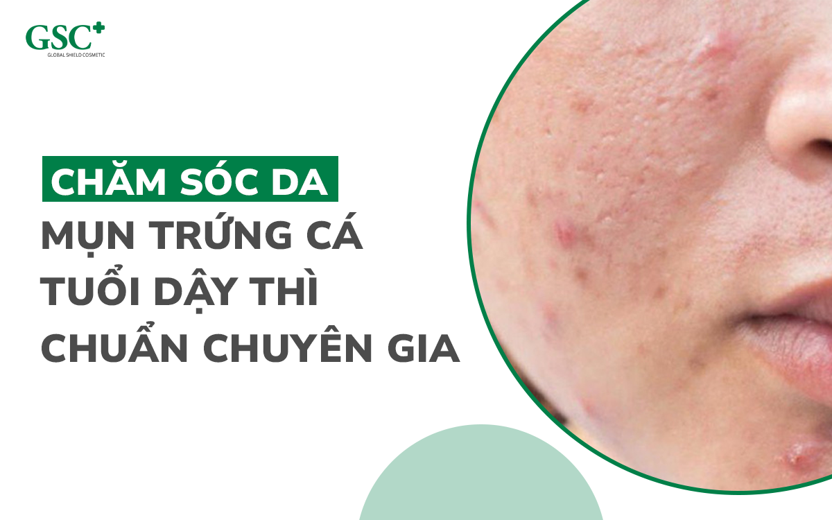 Chăm sóc da mụn trứng cá tuổi dậy thì chuẩn