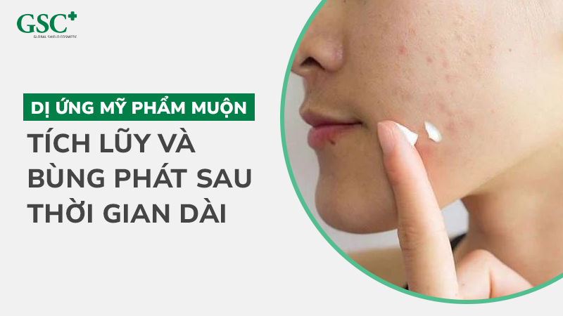 Dị ứng mỹ phẩm muộn