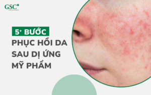 5+ Bước phục hồi da sau dị ứng mỹ phẩm