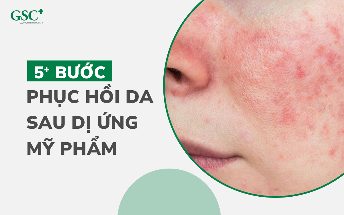 Phục hồi da sau dị ứng mỹ phẩm
