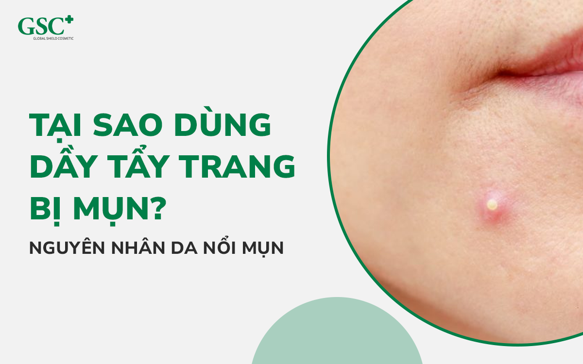 Tại sao dùng dầu tẩy trang bị mụn
