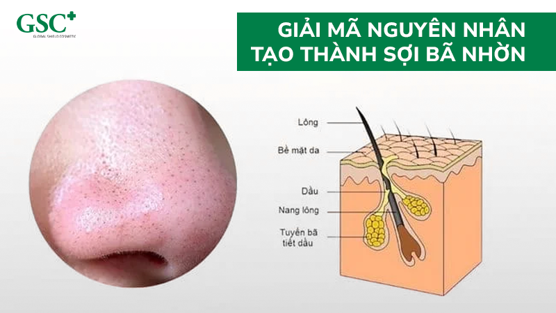 Giải mã nguyên nhân tạo thành sợi bã nhờn