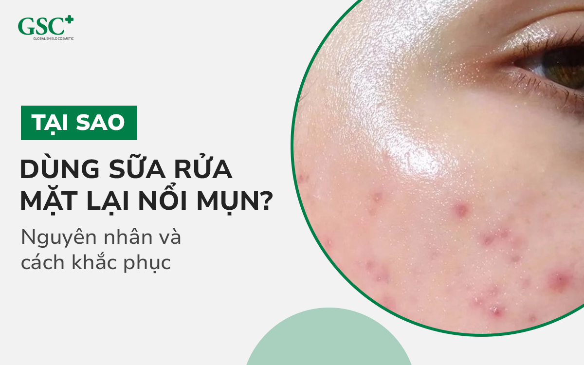 Tại sao dùng sữa rửa mặt lại nổi mụn