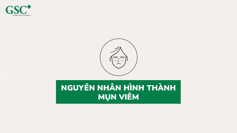 Nguyên nhân hình thành mụn viêm Nguyên nhân hình thành mụn viêm